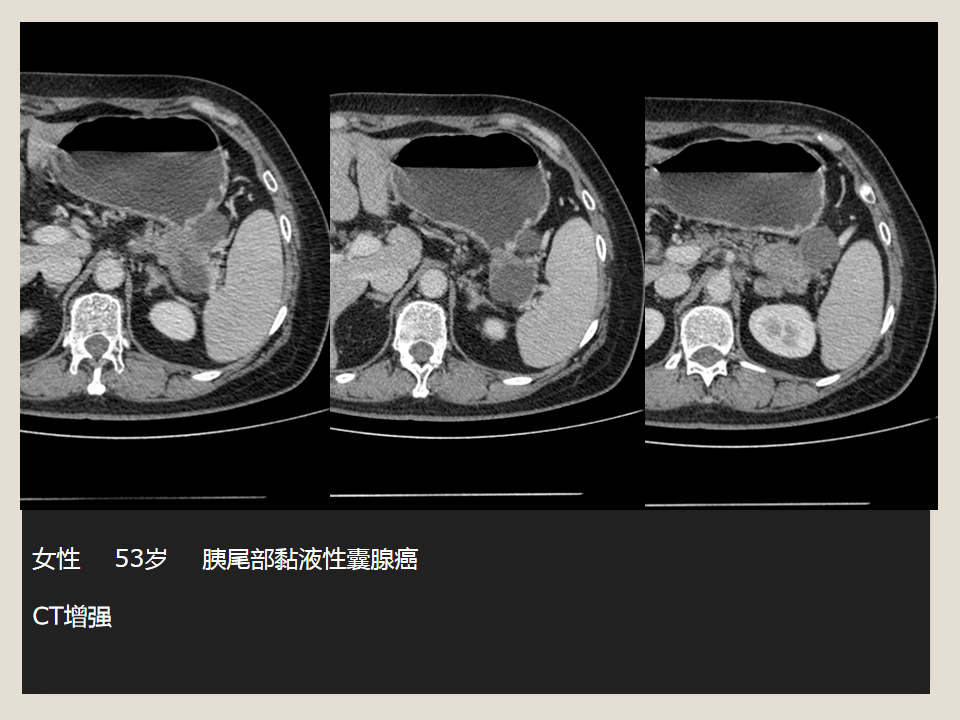 胰腺常见囊性肿瘤的ct表现及鉴别诊断