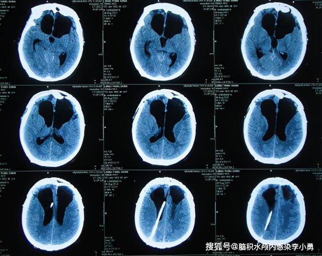 顱腦損傷昏迷術後繼發腦積水,腦室腹腔分流術和顱骨修補術後顱內感染