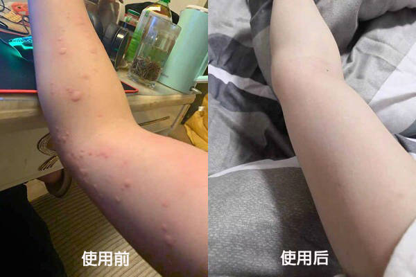 妍芙菁百草荨疹膏,荨麻疹的大救星