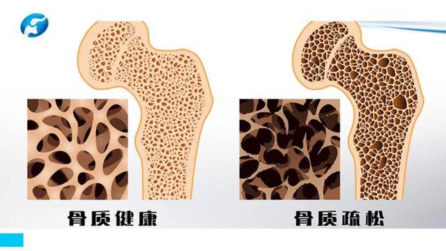 长江主任说脊柱骨质疏松症对脊柱的危害