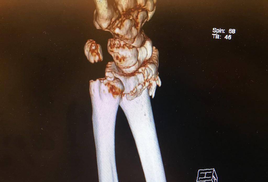 原創吳京突曝謝楠橈骨粉碎性骨折曬ct照裂痕明顯輪椅照也曝光