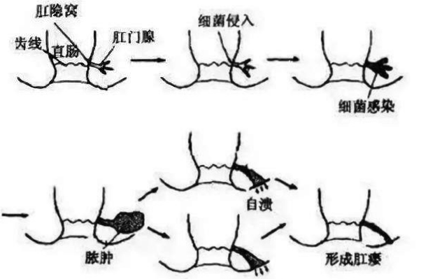 肛瘘一定要做手术吗图片