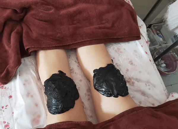 泥灸是一种在人体特定部位通过用泥药热灼和熨烫刺激,以达到治病防病