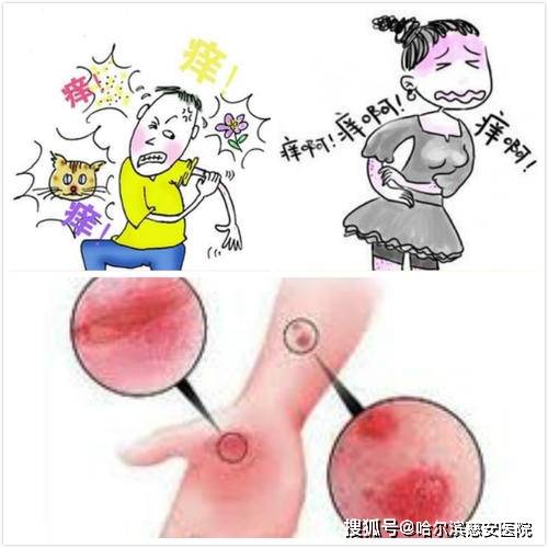 科普乳房溼疹