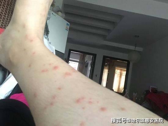 科普丘疹性荨麻疹