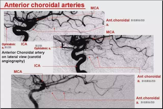 认识脉络膜前动脉:从解剖到临床
