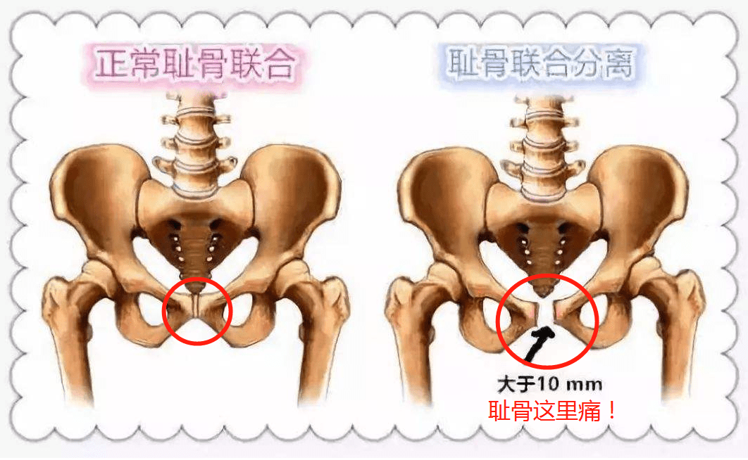 耻骨疼是哪里疼图片