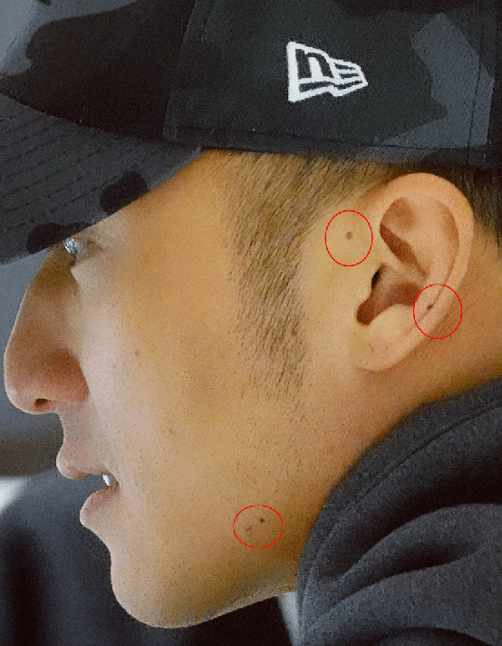 左耳耳屏有痣的男人图片