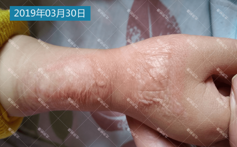 (疤康)小朋友烧烫伤瘢痕一年恢复情况