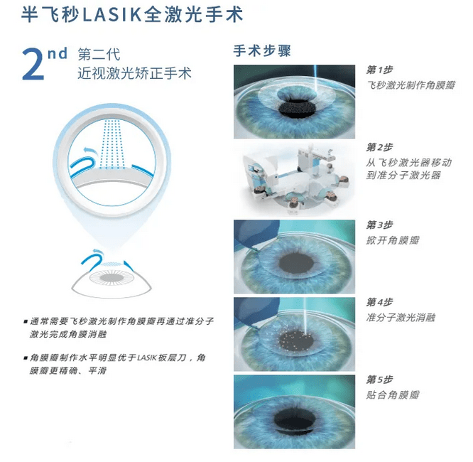 半飞秒激光近视手术原理图