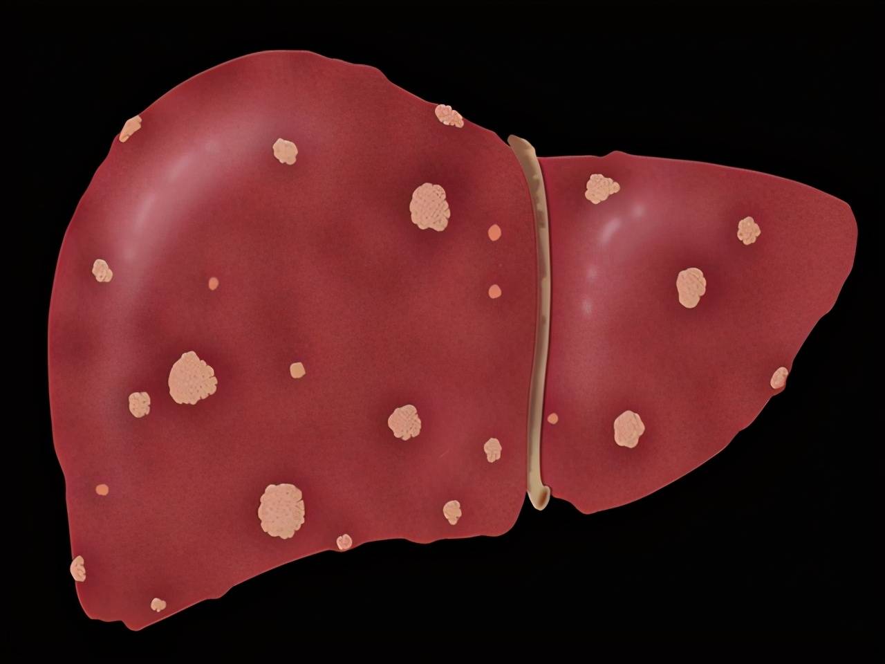 肝病来时不痛不痒,但是身上有几个部位变颜色,就要小心恐怕肝脏有问题