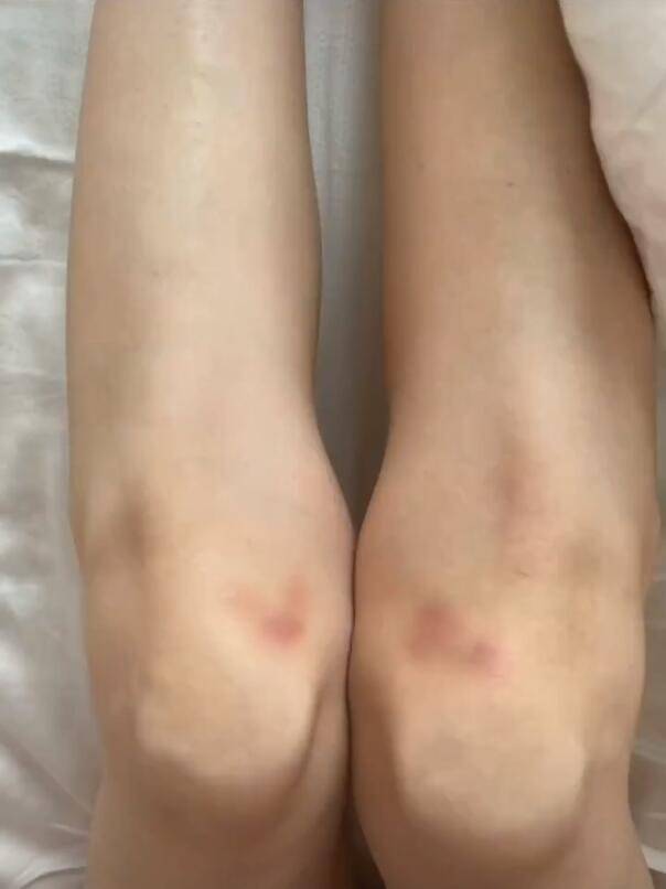 李小璐晒库存照双腿膝盖受伤暴瘦仅80斤甜馨素颜超像贾乃亮