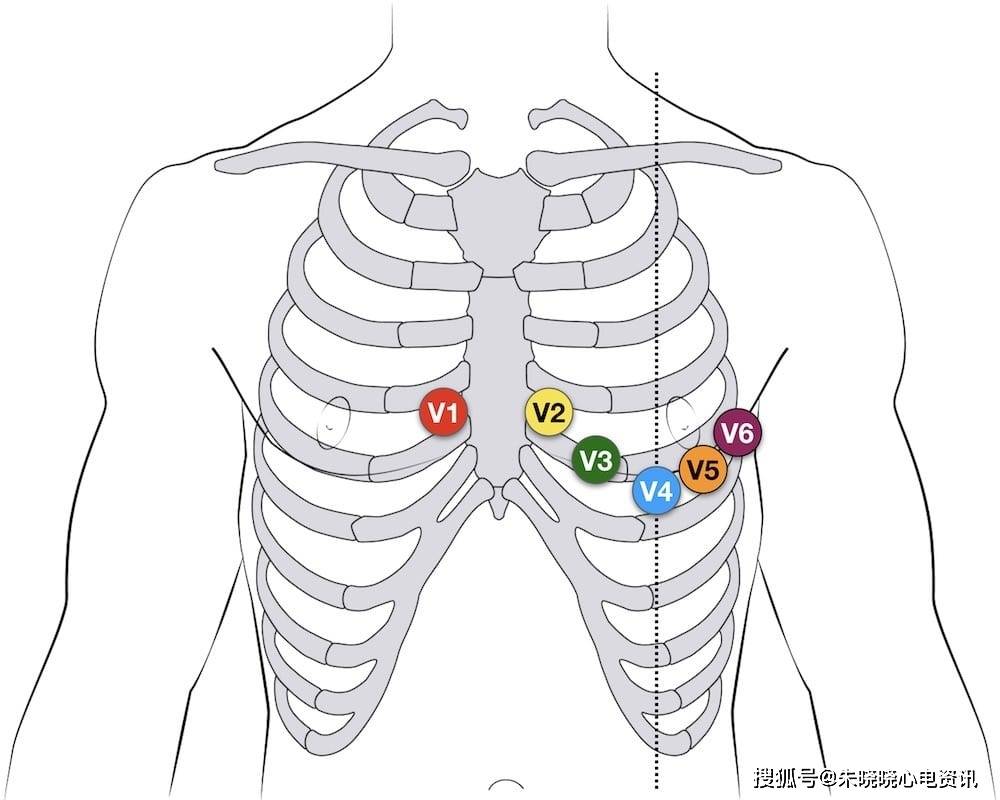 再次略微啰嗦地重复下6个胸导联的位置