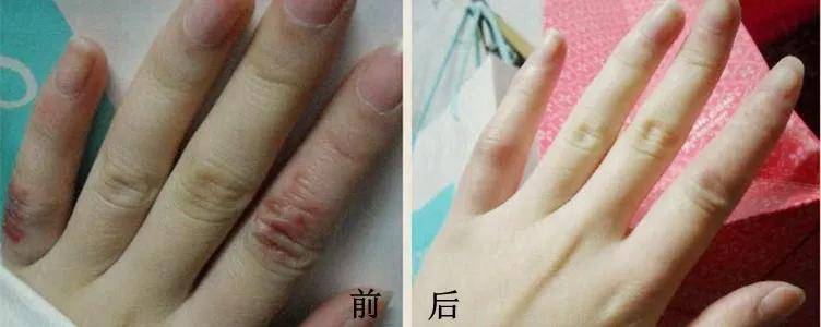 随身的“暖手宝”，告别冻疮烦恼！-搜狐大视野-搜狐新闻