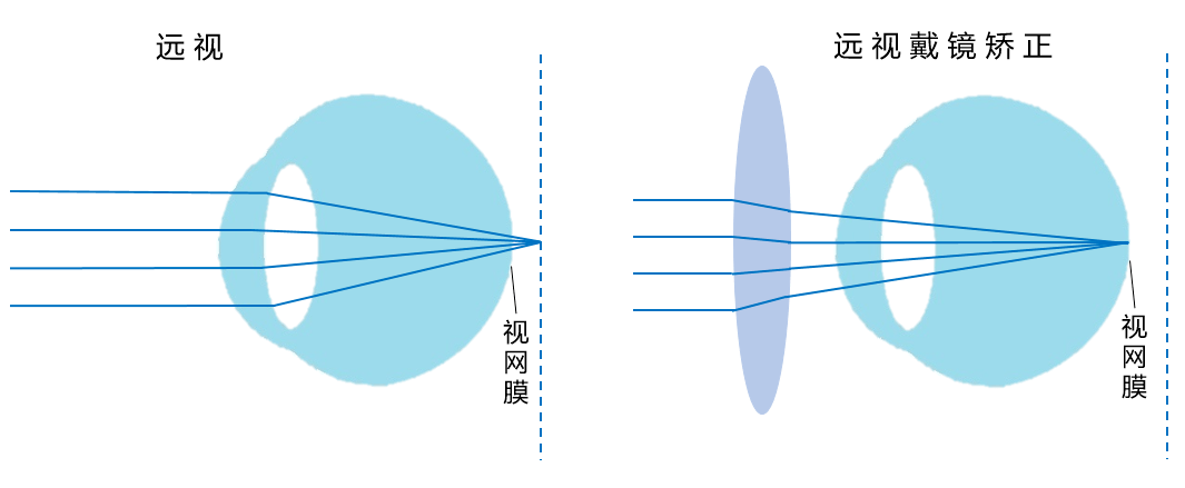 近视,远视,散光,老花,我到底属于哪一种?