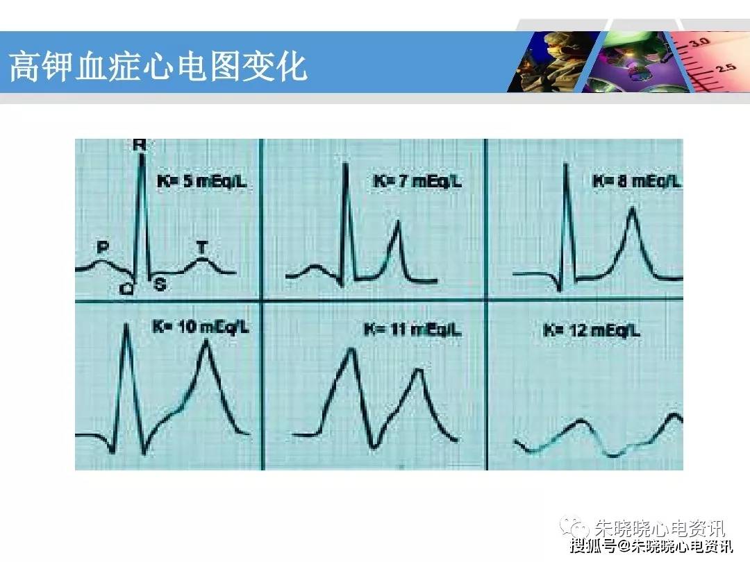 血鉀心電圖治療