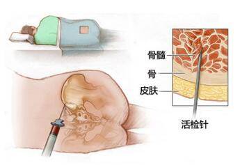 如多次穿刺取材不满意,少数情况下可选胸骨穿刺,只要