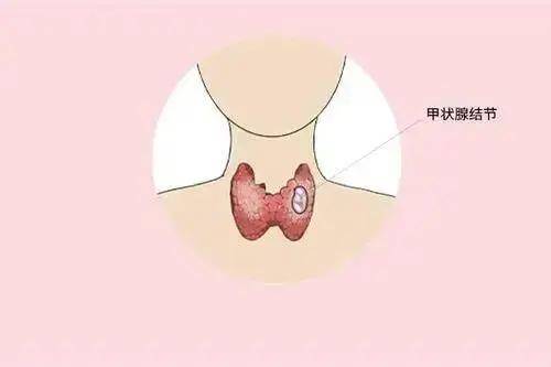 雲南中西醫結合醫院得了甲狀腺結節一定要開刀