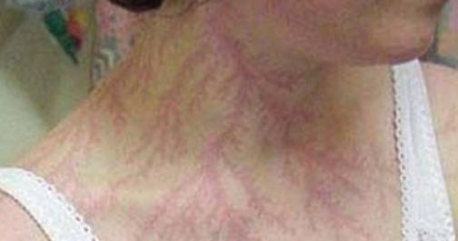 被闪电劈过的人!身上都留下"天然纹身",让人大开眼界