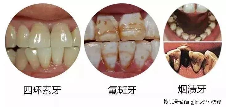 牙黄的原因有很多种,你是哪一种?