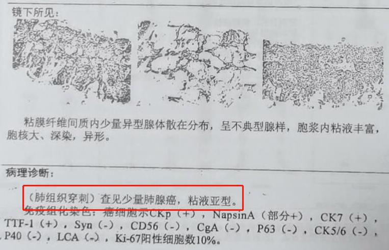 患者福音!80歲肺癌病人,抗癌1個月腫瘤明顯縮小,回家能治療