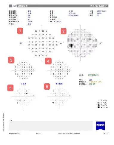 【知识】快速教你看懂视野报告