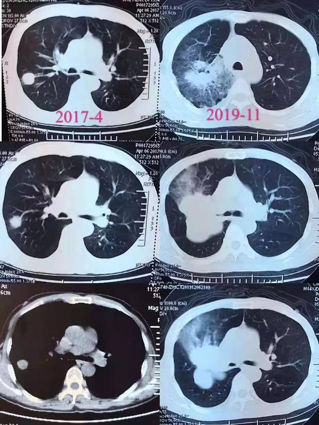 64岁男性患者20岁吸烟30岁戒烟尽管肺癌早期依然无缘手术