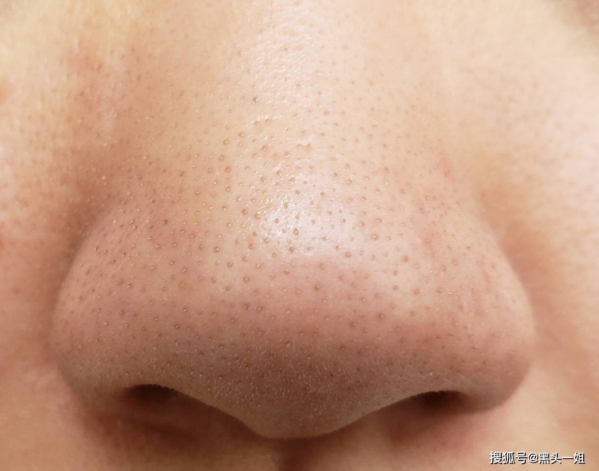 指皮肤新陈代谢出油,分泌的油脂在毛孔里堆积硬化,凝结形成的油脂角栓