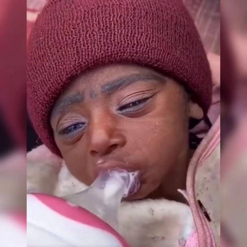 早衰症宝宝喝奶的过程令人揪心不已网友希望可以健康成长