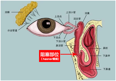 現有的治療方式包括淚囊按摩,淚道探通術等.