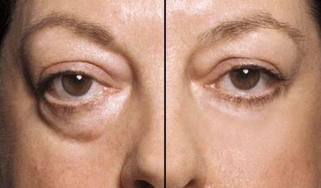 眼袋除了显老还会引起什么样的问题?_严重