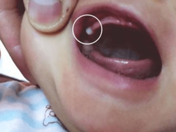 婴儿牙龈外侧白色硬包图片