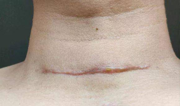 疤痕多久开始干预 83de14bd03a54fa2b0fa9c3a50328220.jpeg