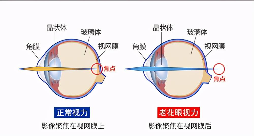 關於飛秒老花近視激光手術與高階老花白內障手術,你知道多少?