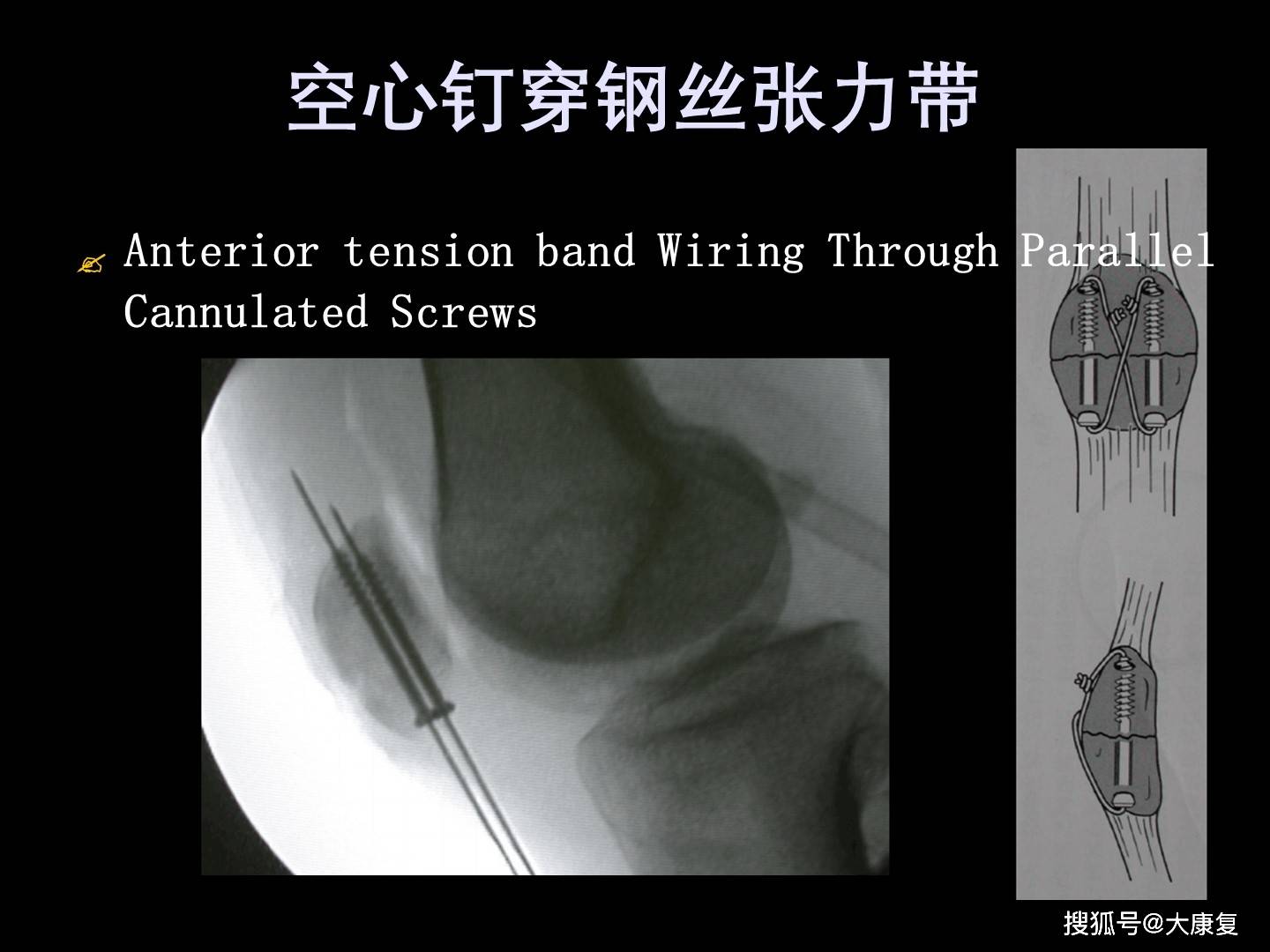 髕骨骨折的應用解剖及手術治療