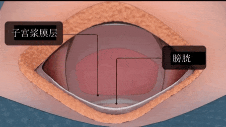 应采儿剖宫产实录原来明星生孩子也要这样