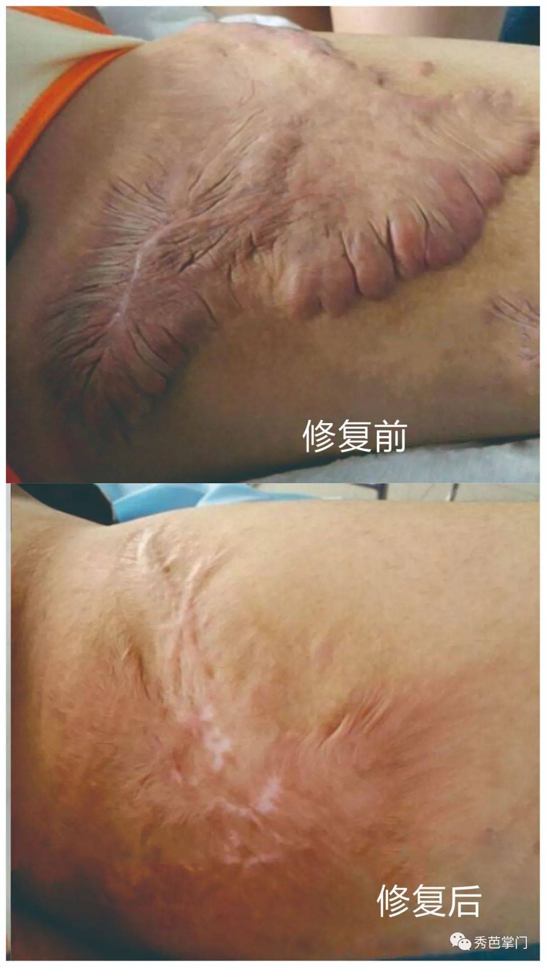 疤痕工厂秀芭掌门告诫疤痕修复趁早不然或成癌