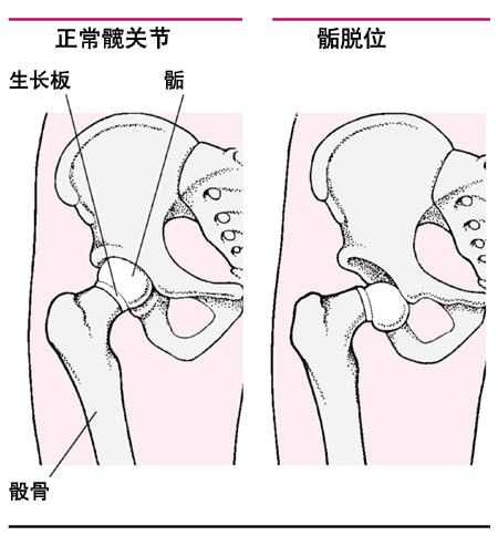 髋关节后脱位图片图片