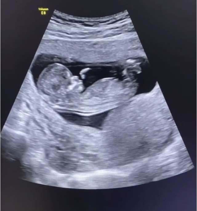 胎儿仰面位示意图图片