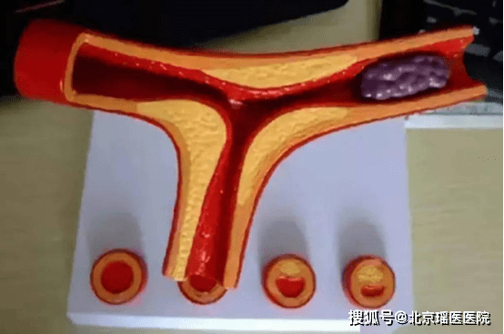 附壁血栓图片