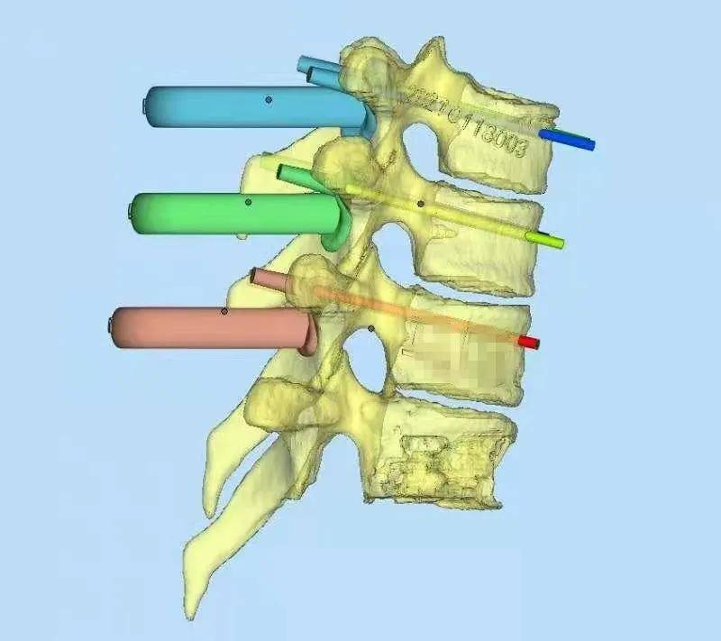 脊柱|外科医生有妙招 3D打印模型模拟手术减风险