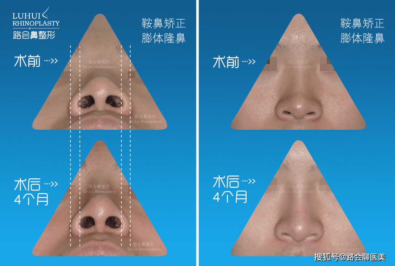 鼻头大鼻翼宽怎么办