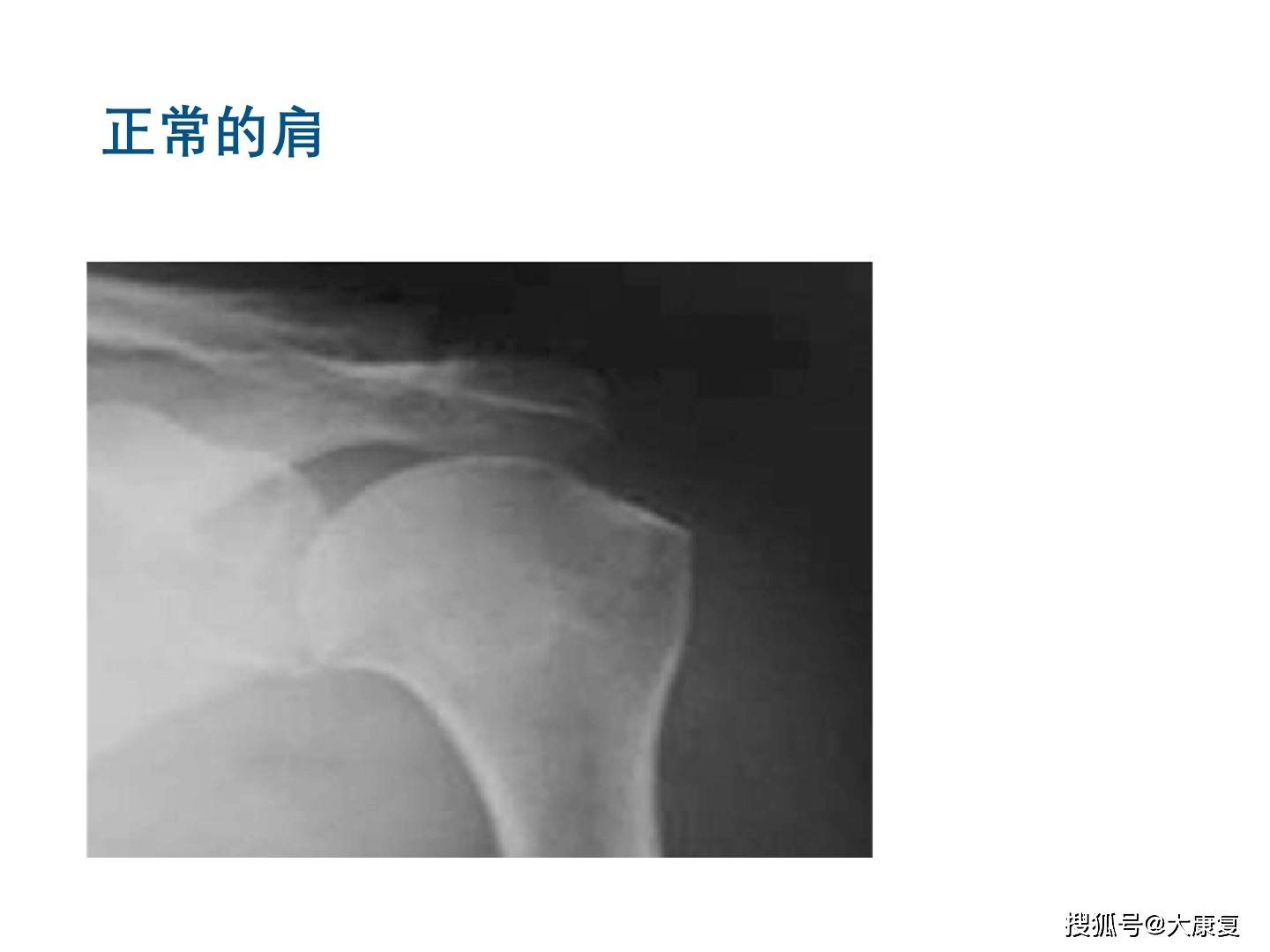 肩关节半脱位的治疗