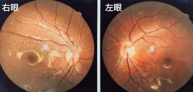 男童躺着玩手机致单眼高度近视加弱视,专家呼吁:假期科学用眼防近视