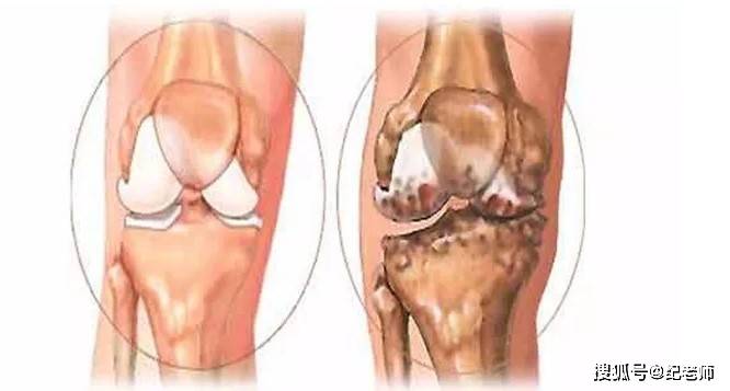 膝盖痛是什么原因 听听纪老师的你就知道膝盖痛怎么治疗效果好 膝关节