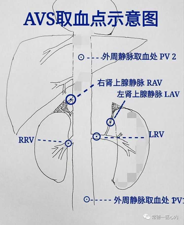 常德市第一人民医院成功开展湘西北首例肾上腺静脉采血