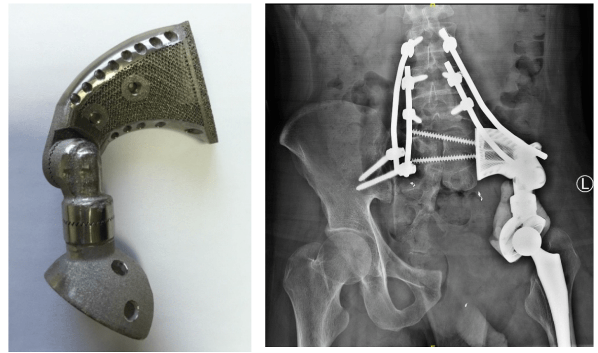 北大人民医院郭卫教授团队3d打印骨盆假体让更多骨盆肿瘤患者受益
