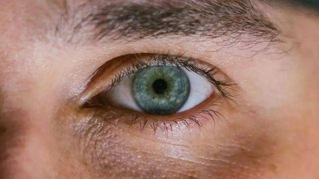 胆固醇高不高,眼睛先知道,若胆固醇偏高的人,多半有这4个现象