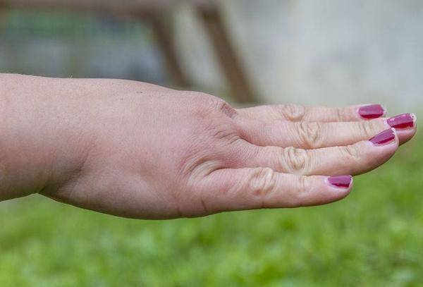 原创血糖高不高手知道手部若有这3种表现当心糖尿病已来临