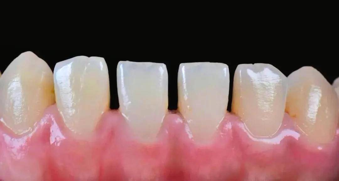 【病例分享】下颌散在牙间隙的关闭